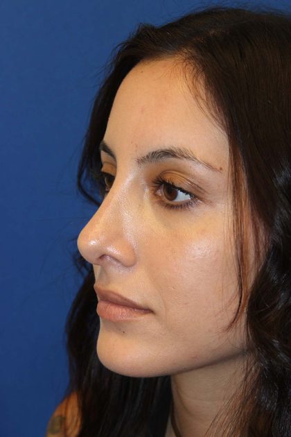 Rhinoplasty Before & After Patient #3573