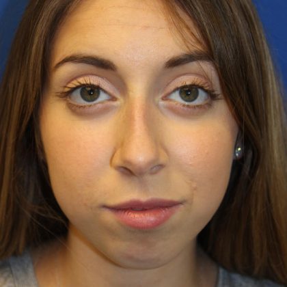 Rhinoplasty Before & After Patient #1620