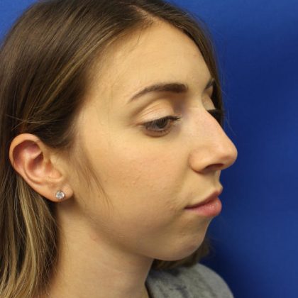 Rhinoplasty Before & After Patient #1620