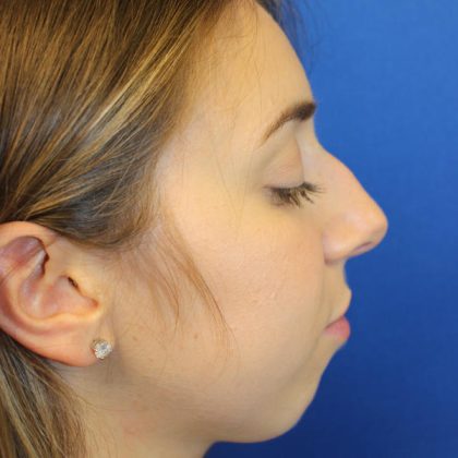 Rhinoplasty Before & After Patient #1620