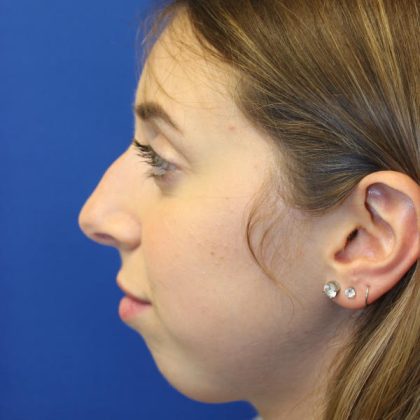 Rhinoplasty Before & After Patient #1620