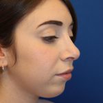 Rhinoplasty Before & After Patient #1620