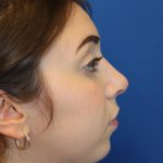 Rhinoplasty Before & After Patient #1620