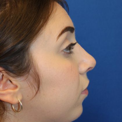 Rhinoplasty Before & After Patient #1620