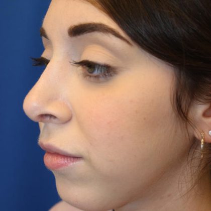 Rhinoplasty Before & After Patient #1620