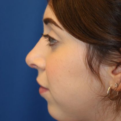 Rhinoplasty Before & After Patient #1620