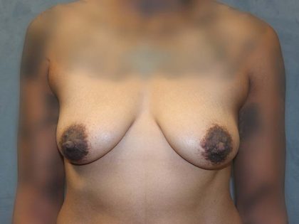 Breast Augmentation Before & After Patient #1595