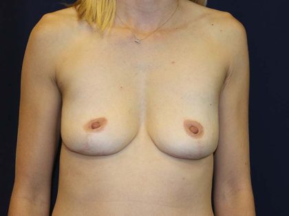 Breast Augmentation Before & After Patient #1494