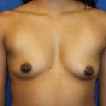 Breast Augmentation Before & After Patient #1619