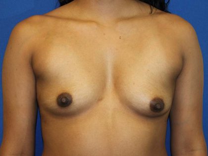 Breast Augmentation Before & After Patient #1619