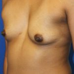 Breast Augmentation Before & After Patient #1619