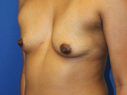 Breast Augmentation Before & After Patient #1619