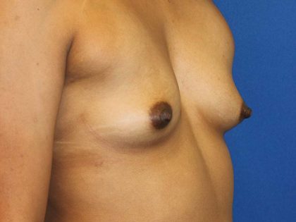 Breast Augmentation Before & After Patient #1619