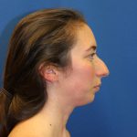 Rhinoplasty Before & After Patient #1530