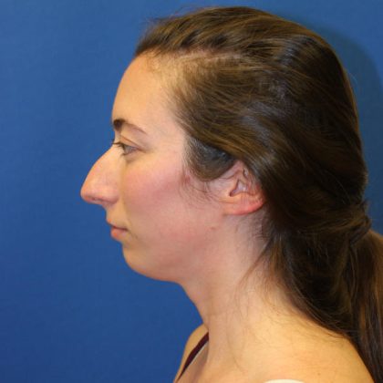 Rhinoplasty Before & After Patient #1530