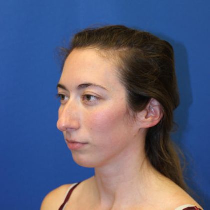 Rhinoplasty Before & After Patient #1530