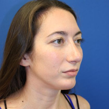 Rhinoplasty Before & After Patient #1530