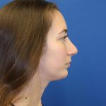 Rhinoplasty Before & After Patient #1530