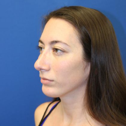 Rhinoplasty Before & After Patient #1530