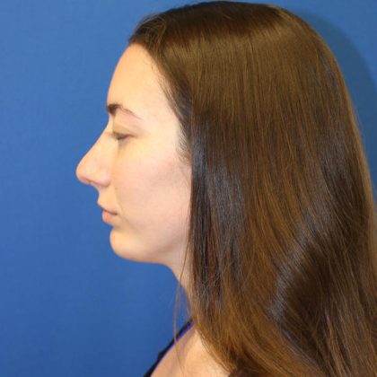 Rhinoplasty Before & After Patient #1530