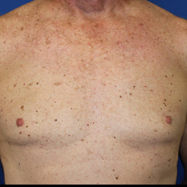 Gynecomastia Surgery Before & After Patient #1789