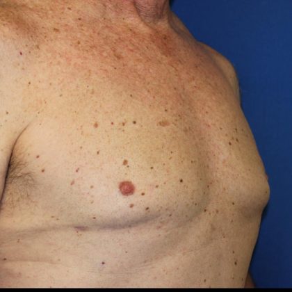 Gynecomastia Surgery Before & After Patient #1789