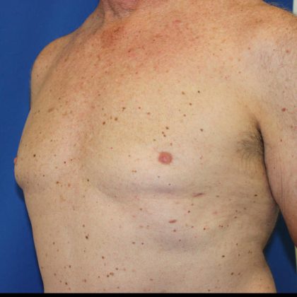 Gynecomastia Surgery Before & After Patient #1789