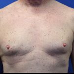 Gynecomastia Surgery Before & After Patient #1789