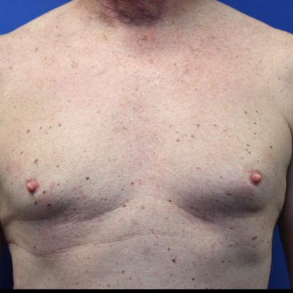 Gynecomastia Surgery Before & After Patient #1789