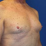 Gynecomastia Surgery Before & After Patient #1789