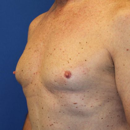 Gynecomastia Surgery Before & After Patient #1789