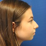 Rhinoplasty Before & After Patient #1544