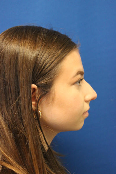 Rhinoplasty Before & After Patient #1544