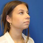 Rhinoplasty Before & After Patient #1544