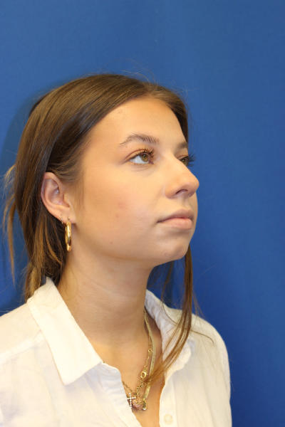 Rhinoplasty Before & After Patient #1544