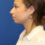 Rhinoplasty Before & After Patient #1544