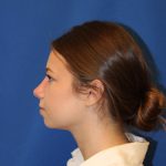 Rhinoplasty Before & After Patient #1544