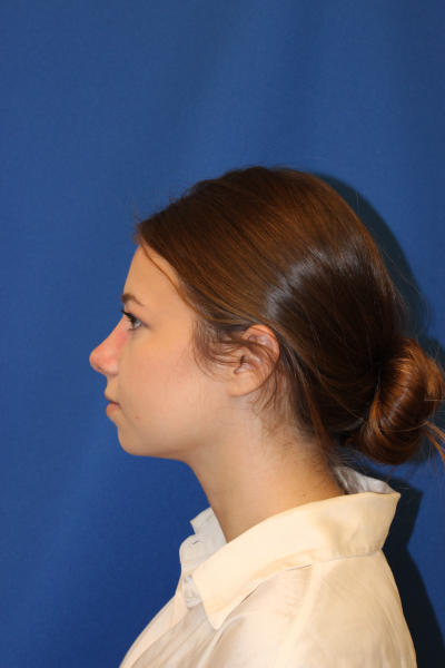 Rhinoplasty Before & After Patient #1544