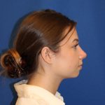 Rhinoplasty Before & After Patient #1544