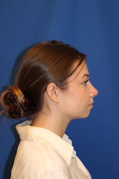 Rhinoplasty Before & After Patient #1544