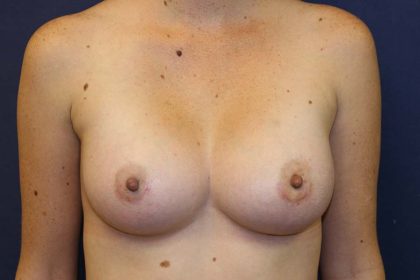 Breast Augmentation Before & After Patient #1476