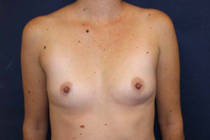 Breast Augmentation Before & After Patient #1476