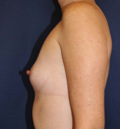 Breast Augmentation Before & After Patient #1476