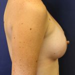 Breast Augmentation Before & After Patient #1476