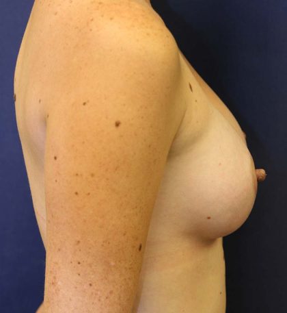 Breast Augmentation Before & After Patient #1476