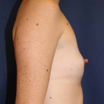 Breast Augmentation Before & After Patient #1476