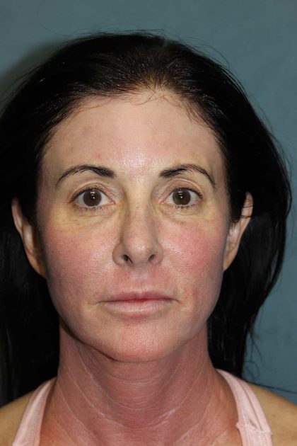 Facelift Before & After Patient #567