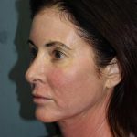 Facelift Before & After Patient #567