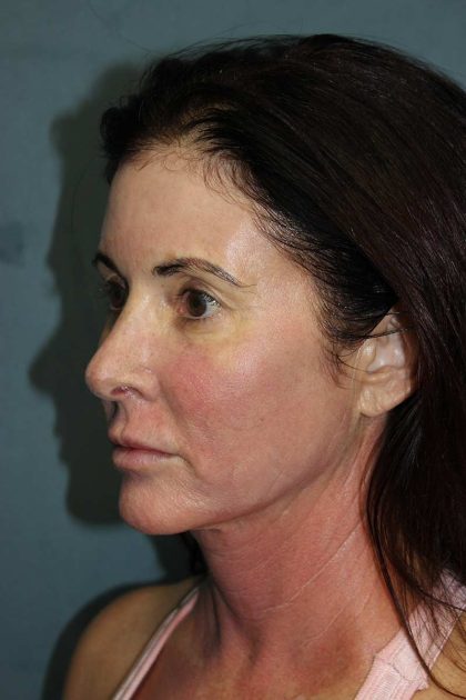 Facelift Before & After Patient #567