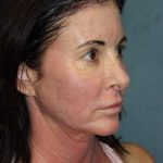 Facelift Before & After Patient #567